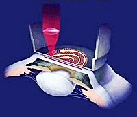 To avoid the side-effects associated with a cut made by a microkeratome blade, the ophthamologist cuts the flap with the laser itself (image courtesy of Intralase).