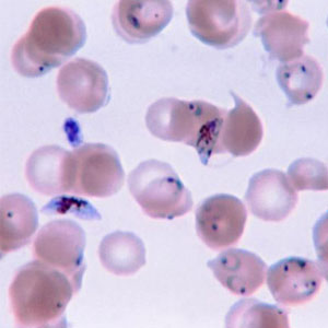 Human blood with parasite causing malaria