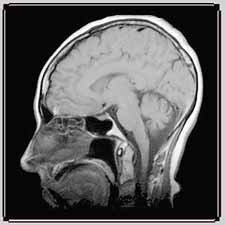 MRI image showing a vertical section of the brain (© 2000 Joseph Hornak, The Basics of MRI)