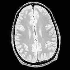 MRI image showing a horizontal section of the brain (© 2000 Joseph Hornak, The Basics of MRI)