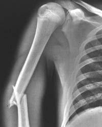  Traditional x-ray of a severely broken arm (Image courtesy of the Mayo Clinic)