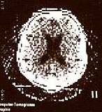 Circa 1975, in the early days of the CT scan.