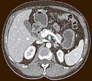 This CT image shows a cross-section of the abdomen. The darker tissue surrounding the abdomen corresponds to a thin layer of fat, and the skin is the very thin white edge of the image. The white, bony structures correspond to the spine (at the bottom center) and short cross-sections of ribs. Blood vessels can be seen at the upper right. (image courtesy of the Mayo Clinic)