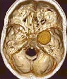 A 3-dimensional (3-D) image of blood vessels within the brain. The large round object is an aneurysm, a ballooning of a blood vessel. The soft-tissue brain matter is not shown in this image. (image courtesy of the Mayo Clinic)