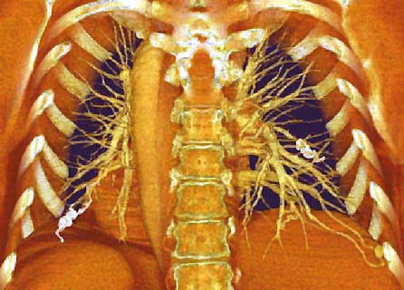 This is a 3-dimensional image of a CT scan of a human chest. Computer processing has removed the front and back of the ribs to reveal bony anatomy (ribs and spine, in white) as well as soft tissue (in red) and blood vessels of the lung (yellow). The carrot-shaped feature is the aorta, the large artery that carries blood from the heart to the body. (image courtesy of the Mayo Clinic)