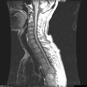 MRI of lower human spine (image used with permission, J.P. Hornak, The Basics of MRI)