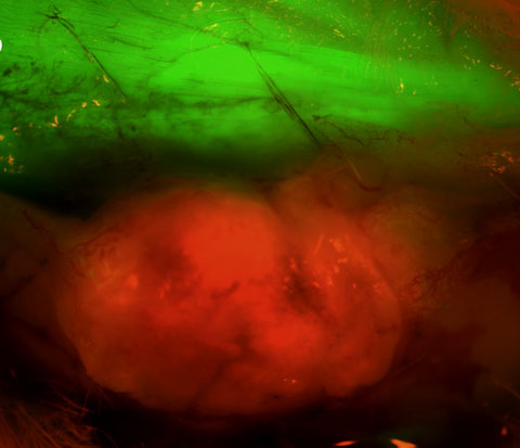 A cancerous tumor (red) surrounded by green host tissue