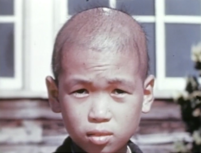 Still image from 1945 Atomic Bomb Casualty Commission film, of a boy exposed to radiation in Nagasaki.